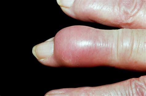 Gout Tophus On The Finger Photograph by Dr P. Marazzi/science Photo Library