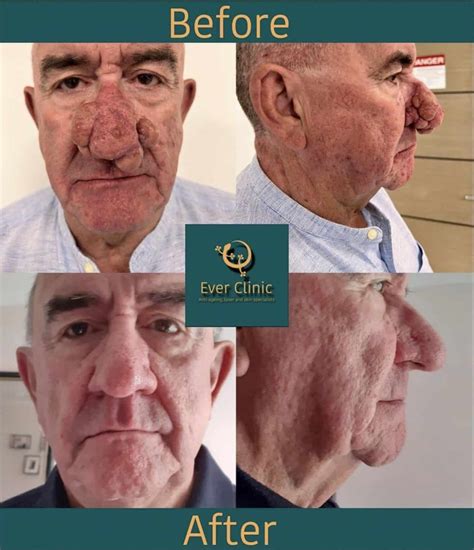 Rhinophyma Treatment Glasgow | Bulbous Nose Laser Surgery