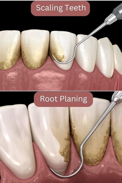 What is the difference between a routine dental cleaning vs scaling and root planing deep cleaning?