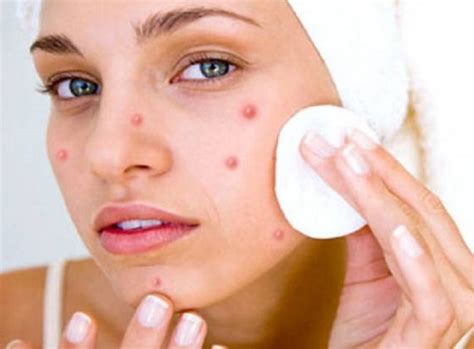 Most Common Causes and Different Types of Pimples - Healthy Flat