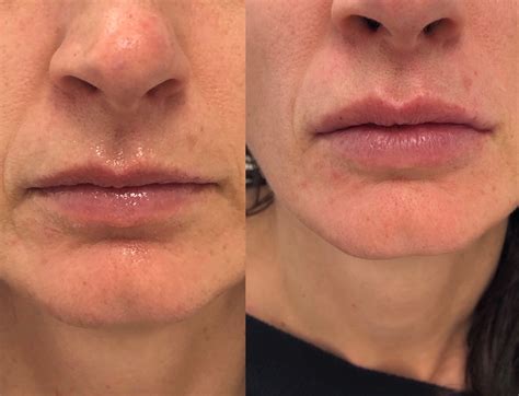 Juvederm Ultra Plus Lip Before After 11 2019 - Elevation Med Spa