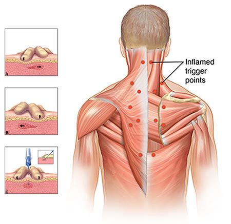 Trigger Point Injection