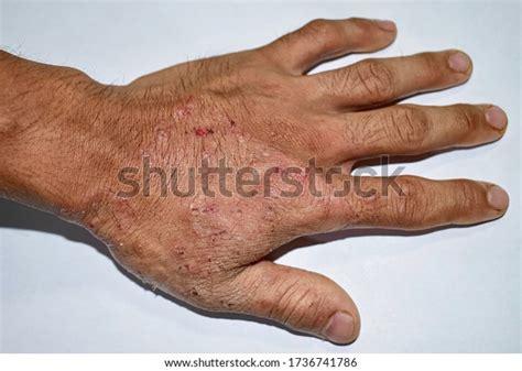 Tinea Manus Fungal Infection On Hand Stock Photo 1736741786 | Shutterstock