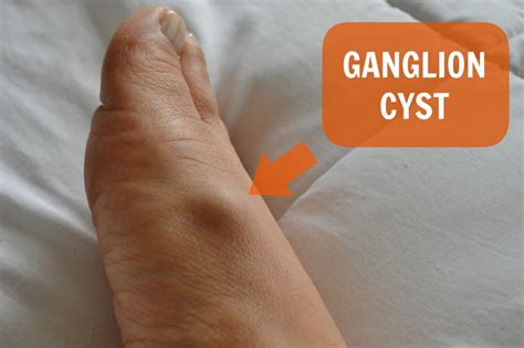 Ganglion Cyst Foot Ultrasound - vrogue.co