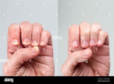 Before and after successful treatment for a onychomycosis or fungal nail infection on damaged ...