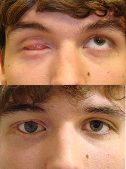 Prosthetic Eye Before And After