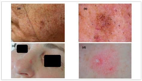 JCM | Free Full-Text | Dermoscopy of Actinic Keratosis: Is There a True ...