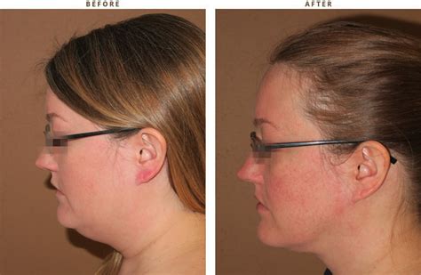 Liposuction of the Neck - Before and After Pictures | Dr Turowski ...