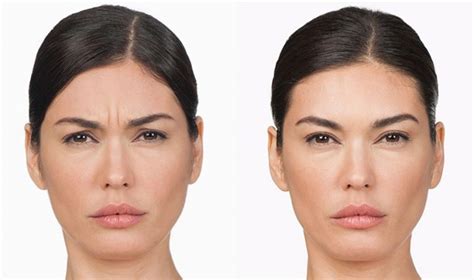 Xeomin vs Botox: Which is Better? - Smooth Synergy Medical Spa & Laser ...