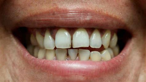 Easy Tips to Remove Stains Between Teeth - Piazza Dental