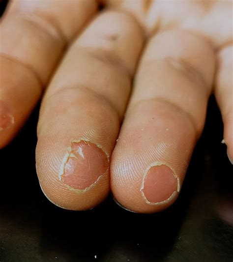 Fingertip Peeling: Causes, Remedies And Prevention