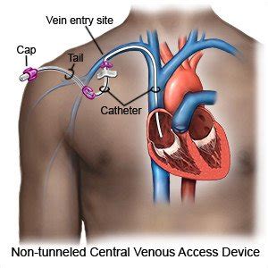 Non Tunneled Central Venous Catheter