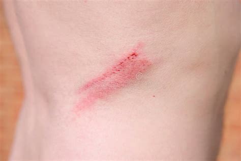 Grazed Skin, Abrasion on a Man`s Back, UK Stock Photo - Image of ...