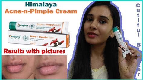 Himalaya Acne-n-Pimple Cream review | How to get rid of acne? Acne ...