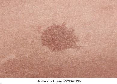 13,558 Birthmark Royalty-Free Images, Stock Photos & Pictures ...