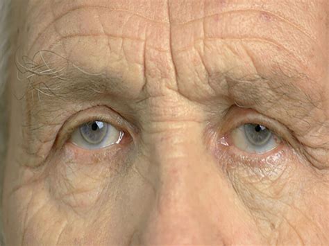 Cataract Surgery: Why second eye Cataract surgery is important?