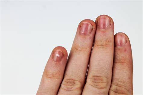 Red Lines On Fingernails - Causes, Prevention & Treatment