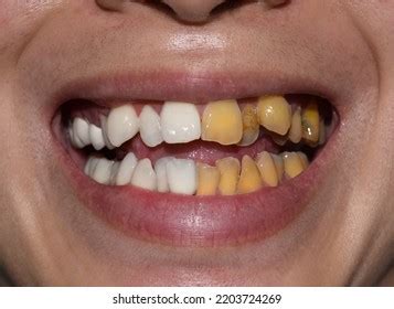 Scaling And Polishing Teeth Royalty-Free Images, Stock Photos & Pictures | Shutterstock