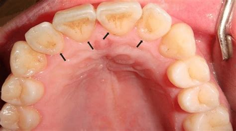 Type I shovel-shaped incisor: Trace shovel. Arrows indicate distinct... | Download Scientific ...