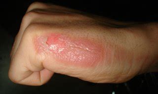 How to Prevent Scarring from a Second Degree Burn - Wound Care Society