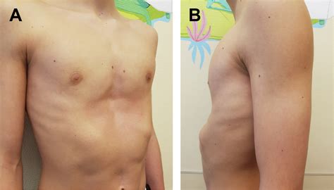 Pectus Excavatum Before And After