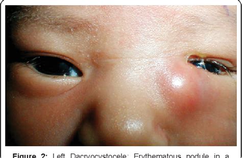 [PDF] Nasolacrimal Duct Obstruction Review | Semantic Scholar