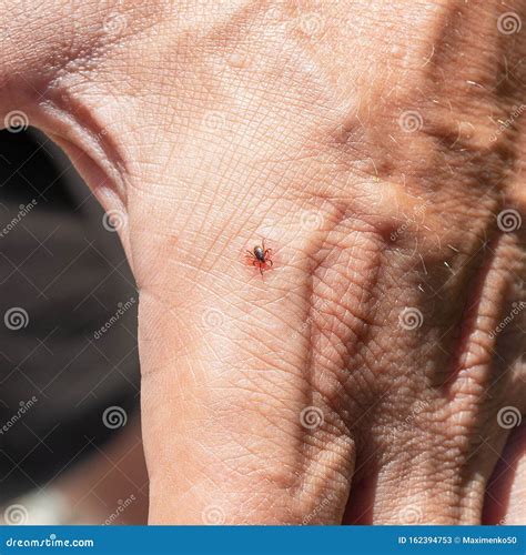 Tick Bit Human Hand. Ixodes Ricinus. Parasitic Mite. Acarus. Dangerous ...