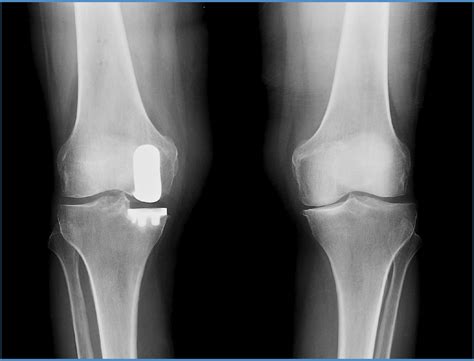 Mako Partial Knee Replacement - Orthopaedic Associates of Muskegon