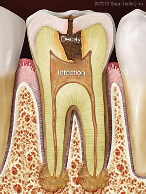 Root Canal Treatment | Beattie Family Dental | Davenport IA