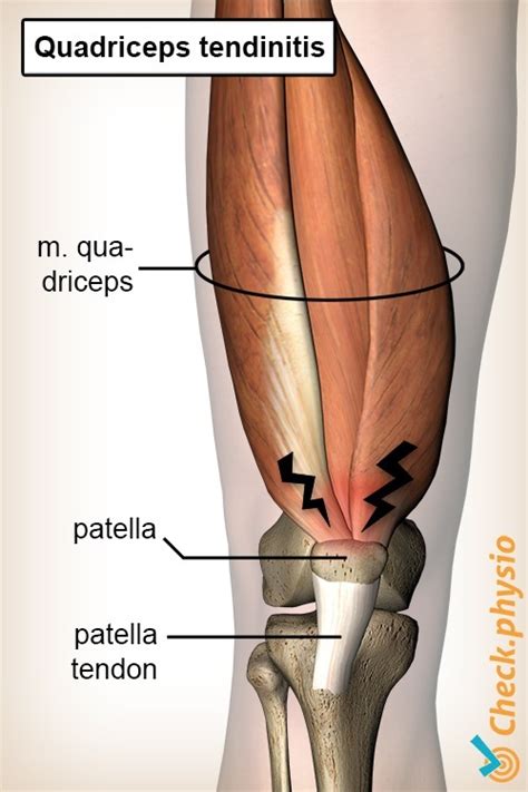 Quadriceps tendinitis | Physio Check