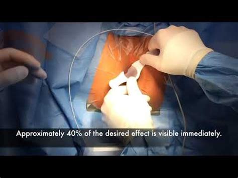 Laser Hemorrhoidoplasty (LHP) - YouTube