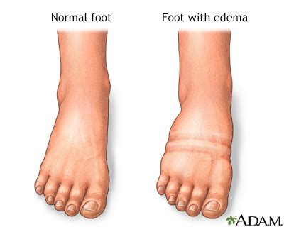 Foot, leg, and ankle swelling - UF Health