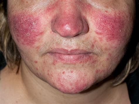 The ‘rosacea diet’ might be your answer to getting rid of adult acne ...