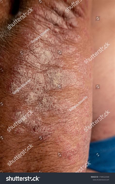 Psoriasis Chronic Inflammatory Autoinmune Skin Disease Stock Photo 1748522540 | Shutterstock