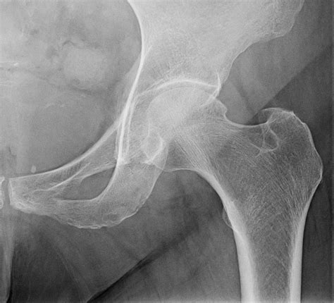 Study shows that high bone mineral density scores are associated with lower risk of painful hip ...