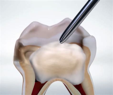 Technique for Primary Molar Tooth Pulpotomy - OdontoVida