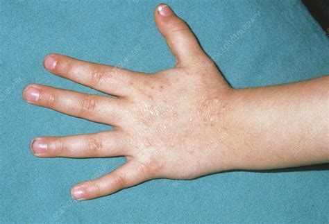 Close up of child's hand with cat allergy eczema - Stock Image - M150/0095 - Science Photo Library