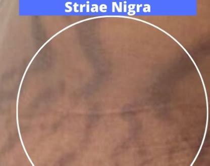 Types of Stretch Marks/ Striae - Phade