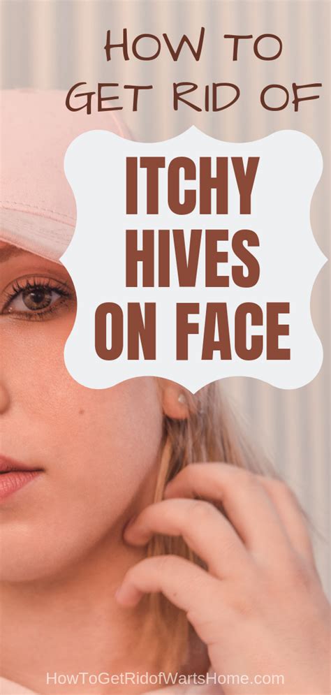 Hives on Face: Causes & Symptoms - How to Get Rid of Facial Rash? | Natural remedies for ...