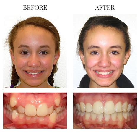 Palate Expander Before And After