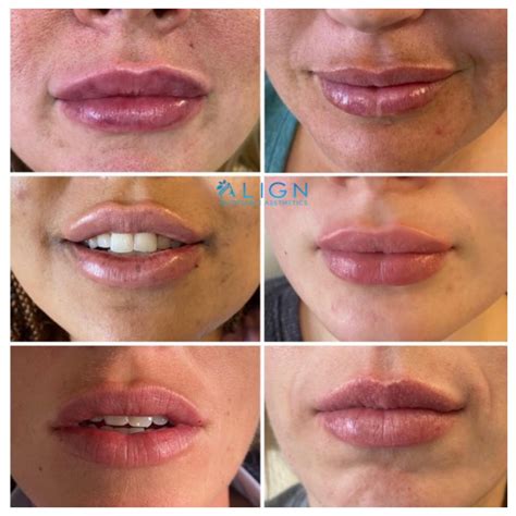 How Soon After Lip Injections Can You Get More? - GA Fashion