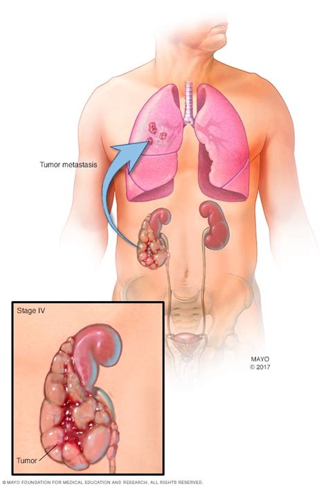 Cáncer de riñón - Diagnóstico y tratamiento - Mayo Clinic