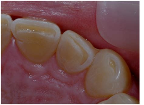 INCISAL EXCURSIVE - Peter Walford Dentistry