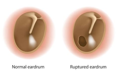 Tympanic Membrane Perforation: So you have a ruptured ear drum, now ...