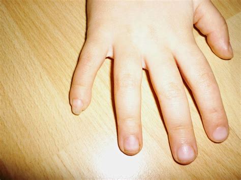 A child with a necrotic finger | BMJ Case Reports