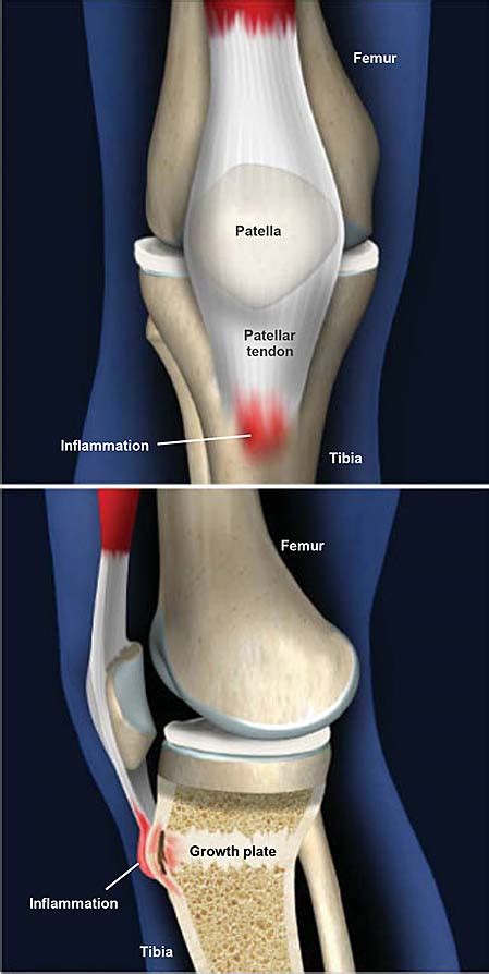 Osgood-Schlatter Disease | Central Coast Orthopedic Medical Group