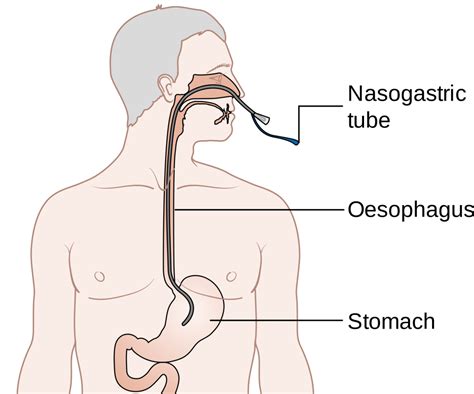 NG Tube - Nasogastric tubes - My experience - So Bad Ass