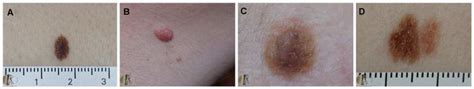 Junctional Melanocytic Nevus