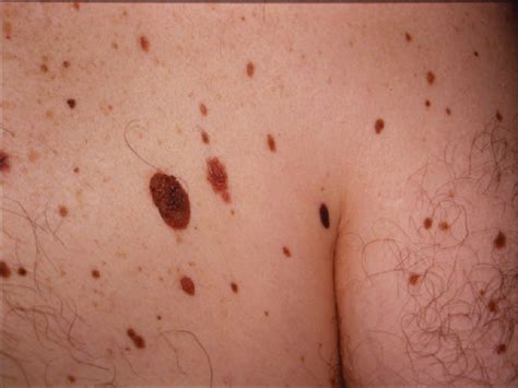 Mole check - Queensland Skin Cancer Clinic