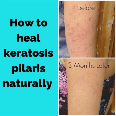 Treatment for Keratosis Pilaris | Keratosis pilaris, Dry skin bumps, Skin bumps